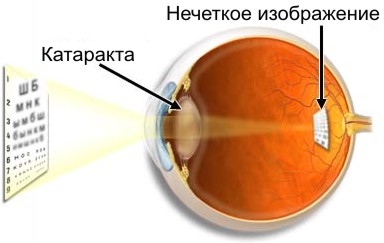 Катаракта вызывает снижение остроты зрения за счет развития помутнений в веществе хрусталика